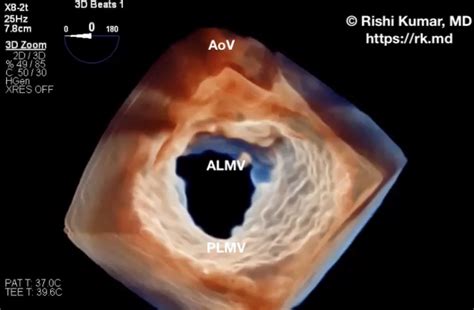 Mitral Valve Leaflet Perforation Rkmd