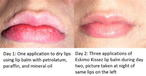 Allergic Reaction On Lips Causes Symptoms And Treatment 59 Off