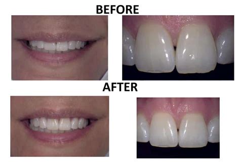 BEST Tooth Contouring in NYC - Before and After Photos of Tooth ...