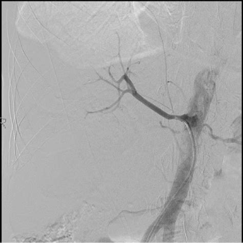 Post Angioplasty Angiogram Showing Satisfactory Resolution Of The Fmd