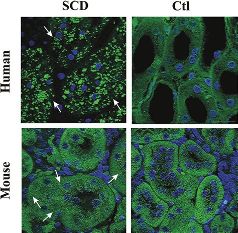 Immunofluorescent Actin Filament Staining In Control And Sickle Cell