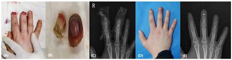 Medicina Free Full Text Comparison Of Hybrid Abdominal Flap Versus