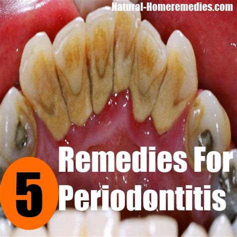 5 Home Remedies For Periodontitis – Natural Cure & Herbal Treatment For Periodontitis | Natural ...