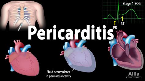 Pericarditis Symptoms Pathophysiology Causes Diagnosis And