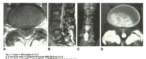 Figure 1 From By Mr Imaging Synovial Cysts Of The Lumbosacral Spine