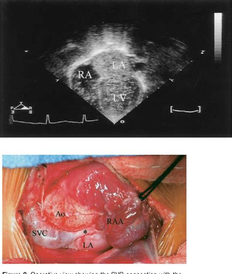 Figure From Echocardiographic Diagnosis Of Anomalous Drainage Of The