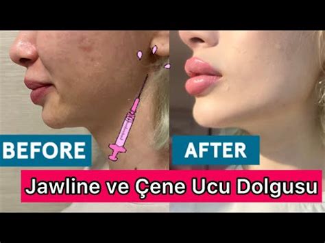 Jawline ve Çene Ucu Dolgusu Yaptırdım 1ml YouTube