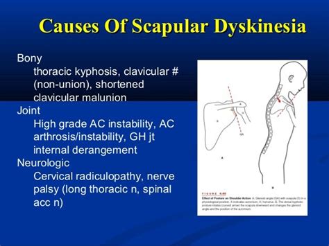 Rotatory cuff syndrome & Scapular Dyskinesia