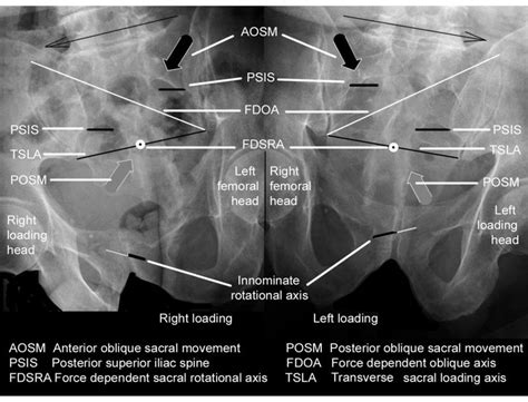 X Rays Taken From The Front Of An Oblique Pelvis In The Long Straddle