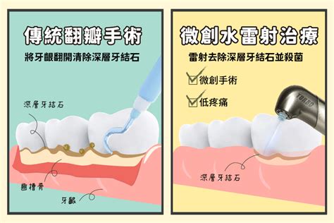 水雷射無痛治療牙周病，怕痛不用瑟瑟發抖 新竹品味牙醫