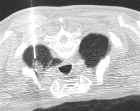 Ct Guided Core Needle Biopsy Of Pulmonary Lesions Associated With