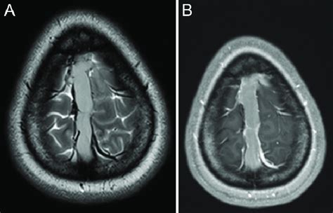 Axial T2 Weighted A And Postcontrast T1 Weighted B Magnetic