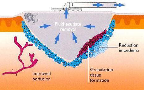 What is a Wound VAC? (with pictures)