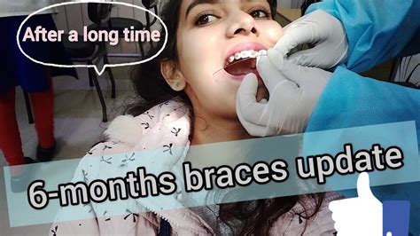 6 Months Braces Update Tightening Of Braces Youtube