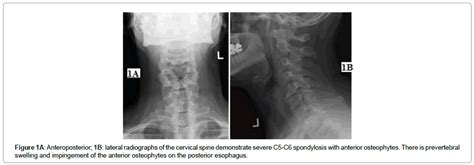 Cervical Osteophytes