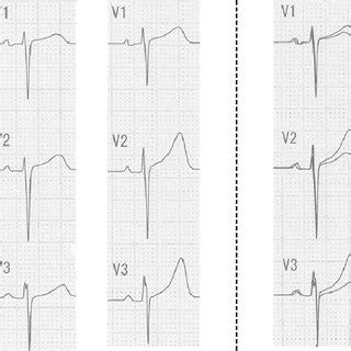 Demonstration Of ST Segment Elevation Of 40 2 MV In The Precordial