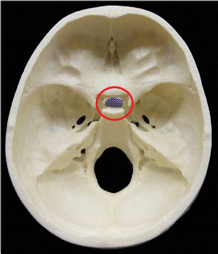 Sella Turcica & Hypophyseal Fossa Flashcards | Quizlet