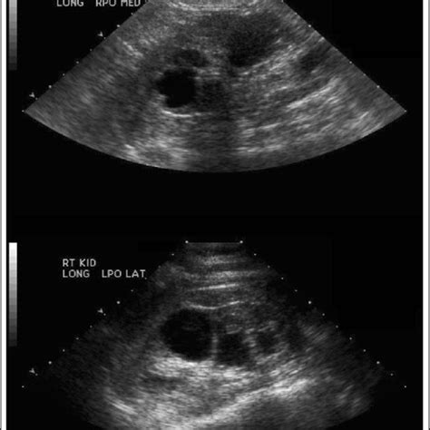 Nephrotic Syndrome Focal Segmental Glomerulosclerosis Sequencing Panel Download Table