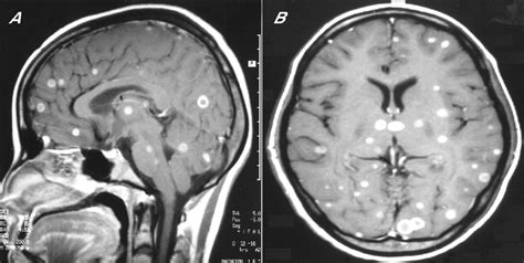 Multiple ring enhancing lesions in brain MRI of a patient with AIDS ...