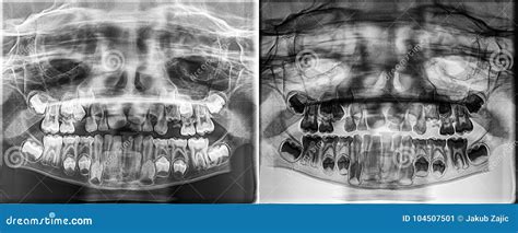 Baby Teeth Panoramic Xray Linkskadel