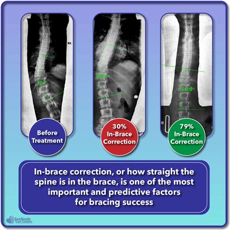 Is Bracing For Scoliosis Effective Fact Check Scoliosis Care Centers