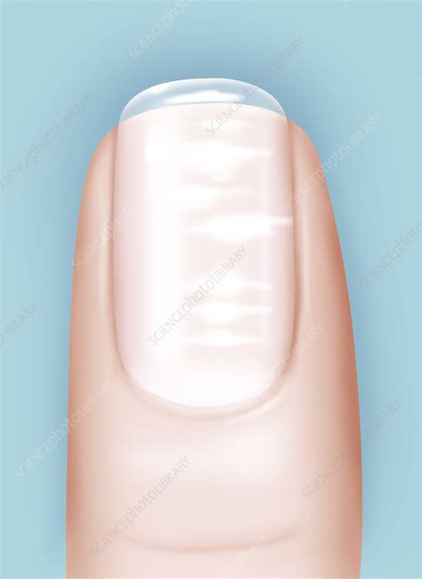 Striated Nail Stock Image C017 2167 Science Photo Library