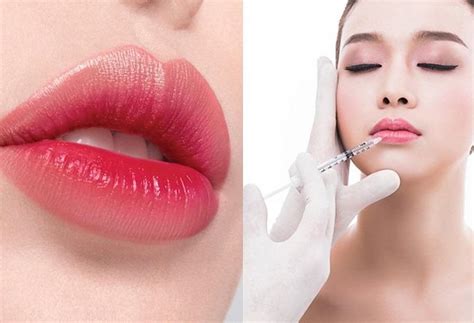 Tiêm filler môi có ảnh hưởng gì không Có hiệu quả bao lâu Chi tiết