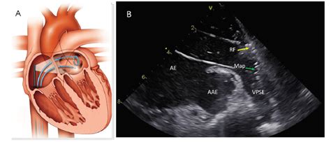 Fibrilação Atrial Parte 2 Ablação Por Cateter Abc Cardiol