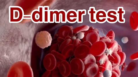 D Dimer Test What Infections Cause Elevated D Dimer Is Elevated D