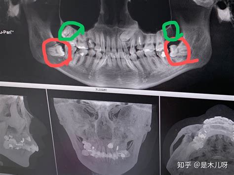 智齿横着长是一种怎样的体验