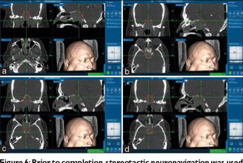 Figure 3 From A Rare Case Of Giant Cell Tumor Involving The Clivus Resected Through Le Fort I