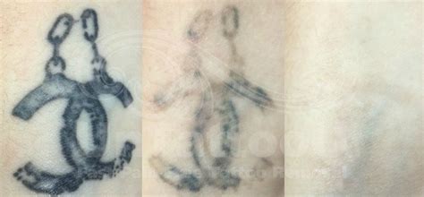 clean slate tattoo removal - Mozell Broussard