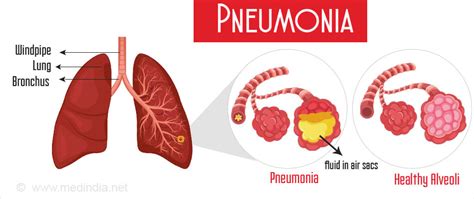 Pneumonia Causes Symptoms Diagnosis Treatment Prevention