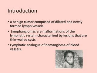 Lymphangioma | PPT