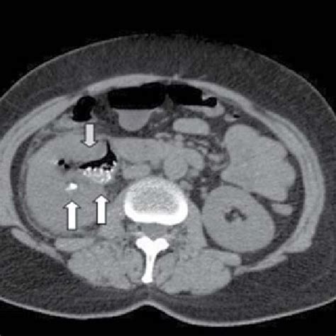 Abdominal Computed Tomography Without Contrast Of The Patient Shows