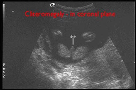 Ambiguous Genitalia Ultrasound