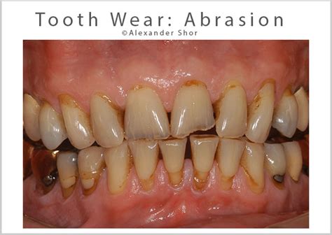 Abrasion Teeth