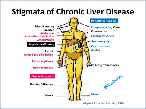 Stigmata Of Liver Disease Stigmata Of Liver Disease In A Cirrhotic Patient Diseases Club Center 2