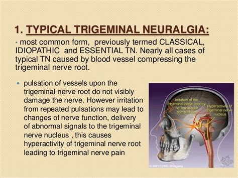 Trigeminal Neuralgia