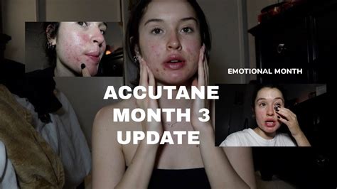 My Accutane Journey Month 3 Youtube