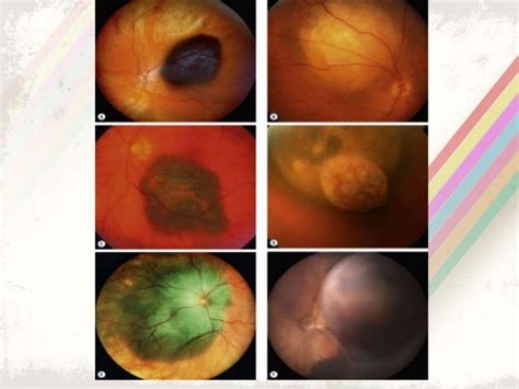 Choroidal melanoma