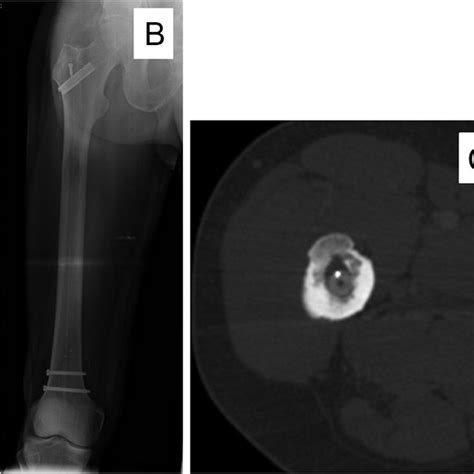 A A 63 Year Old Male With Right Femur Diaphyseal Metastasis From Lung Download Scientific