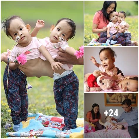 Inseparable Souls Navigating Life S Challenges As Conjoined Twins