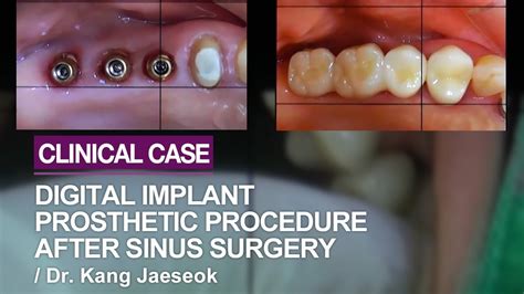 Digital Guided Sinus Lifting With Hydraulic Pressure Part 2 Youtube