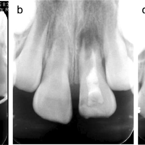 Periapical Radiographs Of Tooth 11 Avulsion Over The 7 Month