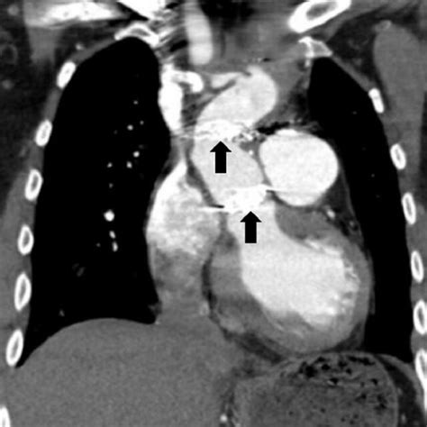 Ct Angiogram Of The Chest Axial View Note The Pseudoaneurysm Inferior Download Scientific