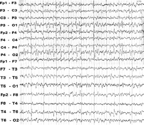 Triphasic waves eeg - nasadvip