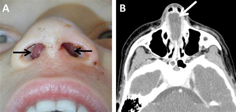 Septal Hematoma Always Think About It The Journal Of Pediatrics