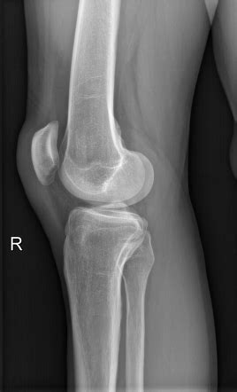 Prepatellar Bursitis Radiology Case Radiopaedia Org