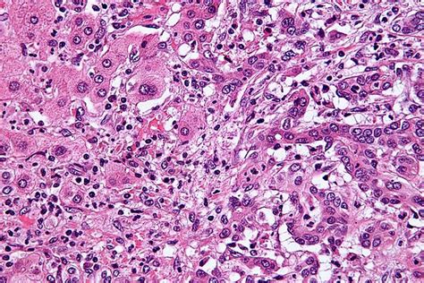 Cholangiocarcinoma Wikipedia